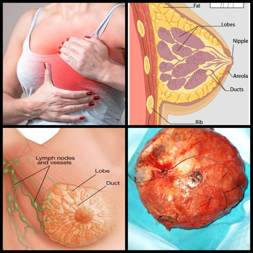 सहारा हॉस्पिटल में स्तन सम्बन्धी रोगों की समस्याओं के निराकरण पर दिया गया बल