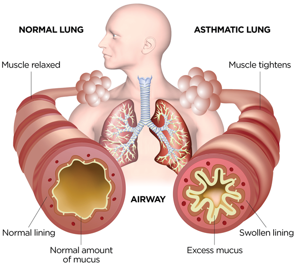 "World Asthma Day 2024: Uncovering Misconceptions and Promoting Awareness"