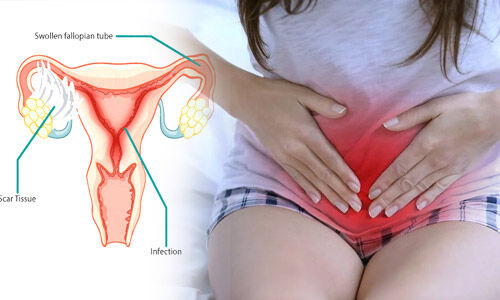 The Benefits of Kegel Exercises - Strengthening the Pelvic Floor and Managing PCOS and Endometriosis