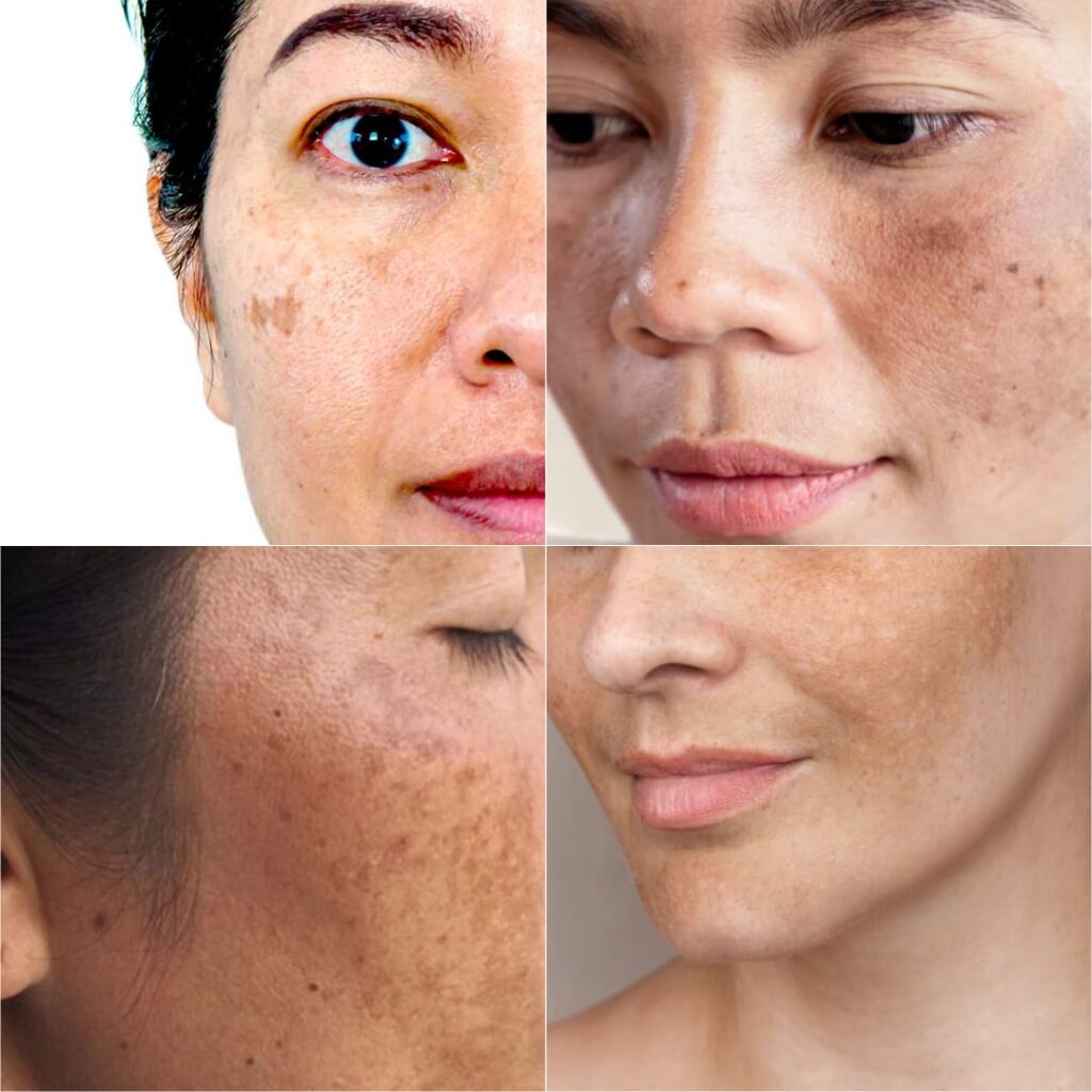 Hidden Health Indicators Behind Melasma in Women –Know the Facts?